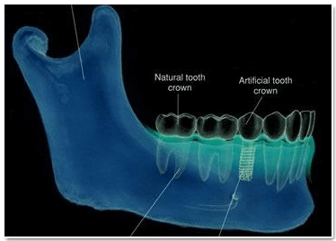 Dental implantlar