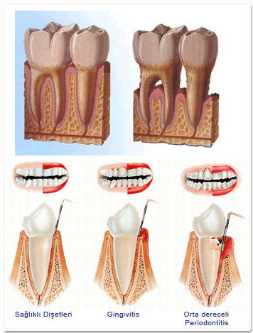 Periodontoloji