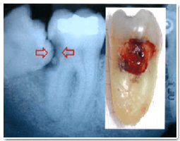 Impacted or Semi impacted Teeth