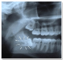 Semi impacted Teeth