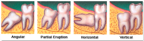 Extraction Indications of Impacted Teeth 