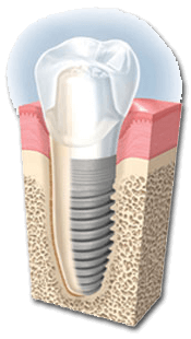 implant diş