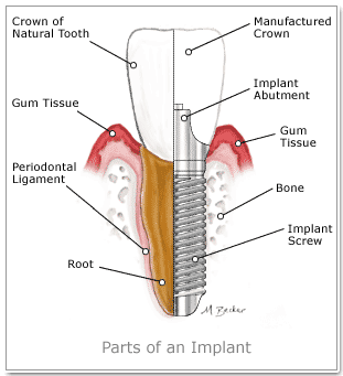 implant parçaları